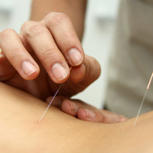 Acupuntura