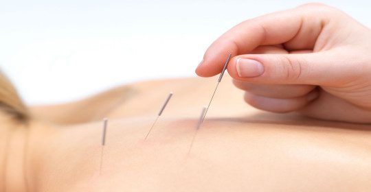 Acupuntura: El Camino Natural hacia el Bienestar