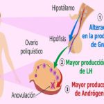SÍNDROME DE OVARIO POLIQUÍSTICO